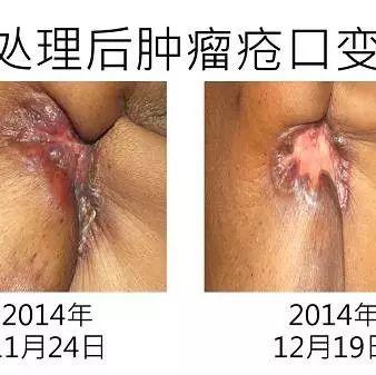 乳癌案例(若斯玲)(簡體版)-七不姜 生姜養生網-明德CSA生態姜園&明安農業