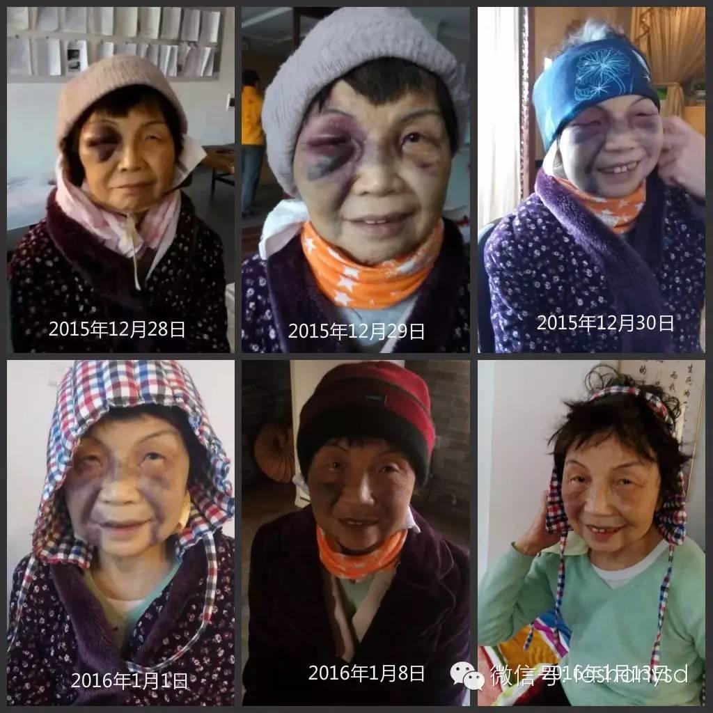 原始點處理摔傷淤腫杠杠的
