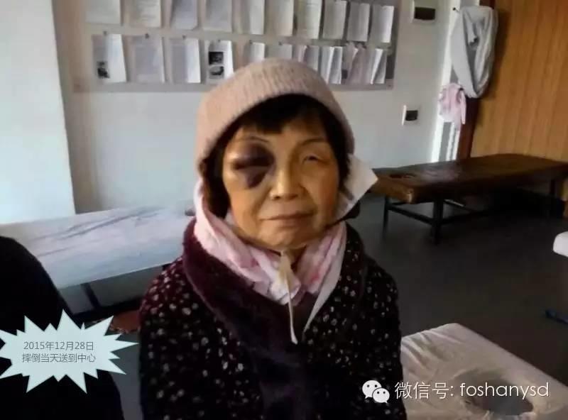 原始點處理摔傷淤腫杠杠的