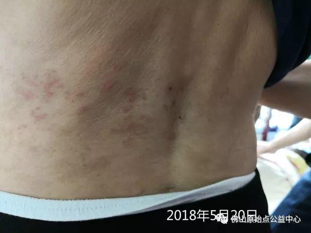 原始點調理帶狀皰疹:輕松快捷效果好 原始點調理帶狀皰疹:輕松快捷效果好