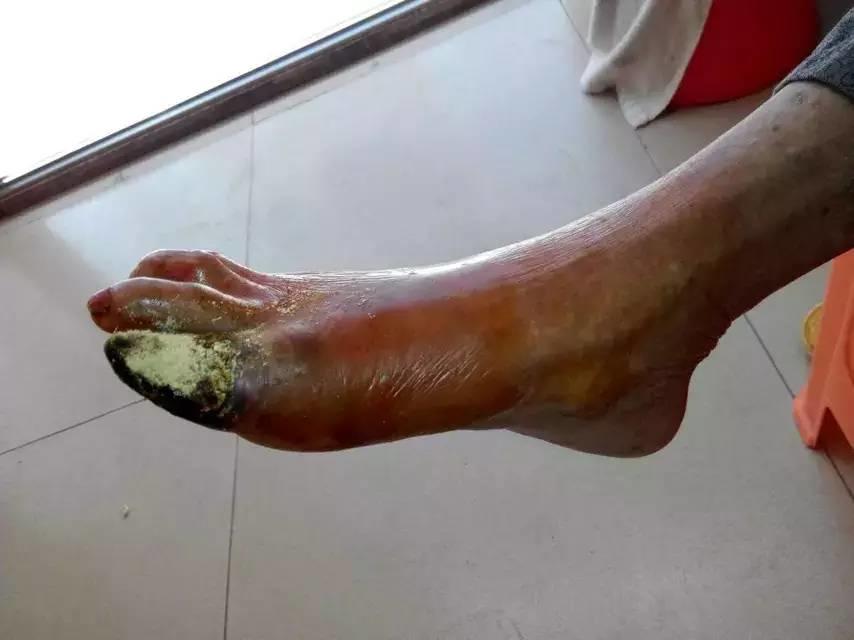 中國大陸“黑腳阿媽”感恩原始點讓她免遭截肢之苦