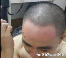 原始點調理九年史牛皮癬:二十天大變化 原始點調理九年史牛皮癬:二十天大變化