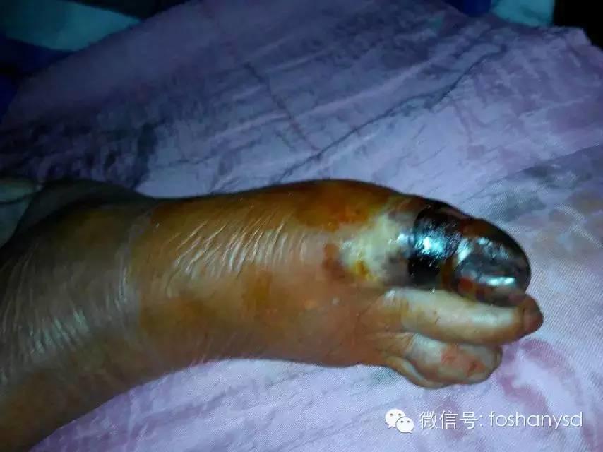 中國大陸“黑腳阿媽”感恩原始點讓她免遭截肢之苦
