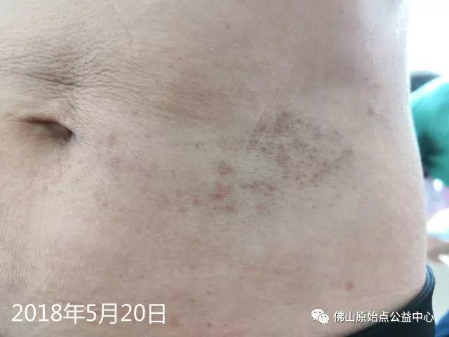 原始點調理帶狀皰疹:輕松快捷效果好 原始點調理帶狀皰疹:輕松快捷效果好