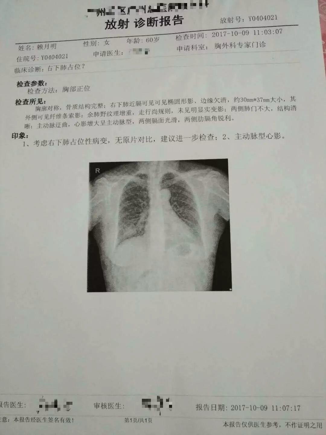 原始點調理肺部腫瘤：細節到位效果好