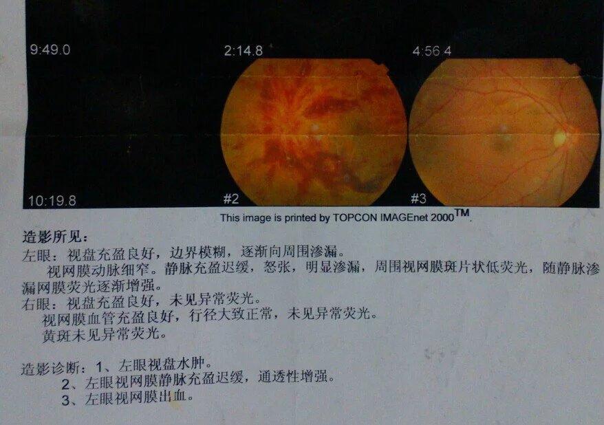 原始點挽救接近失明邊緣小伙的眼睛