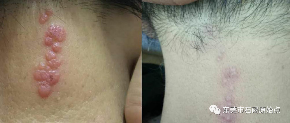 疑似帶狀泡疹-七不姜 生姜養生網-明德CSA生態姜園&明安農業