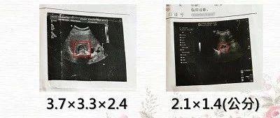 腎上腺瘤免除手術案例-七不姜 生姜養生網-明德CSA生態姜園&明安農業