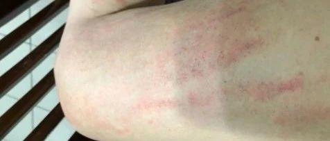 ?金門原始點  蕁麻疹案例-七不姜 生姜養生網-明德CSA生態姜園&明安農業