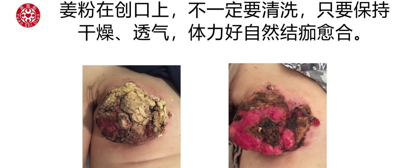 乳癌處理解說-七不姜 生姜養生網-明德CSA生態姜園&明安農業