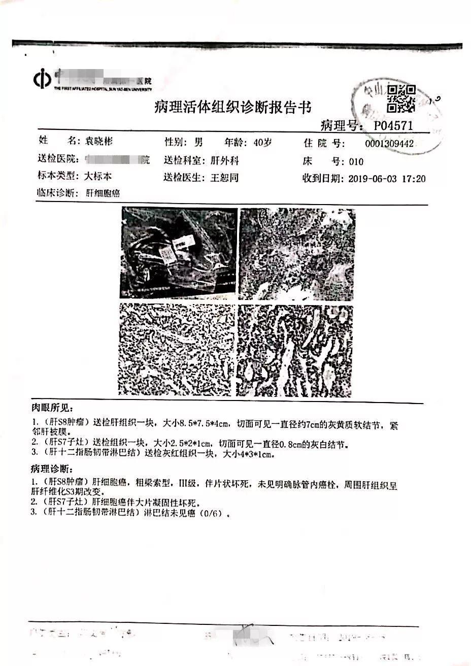 原始點調理肝腫瘤案例