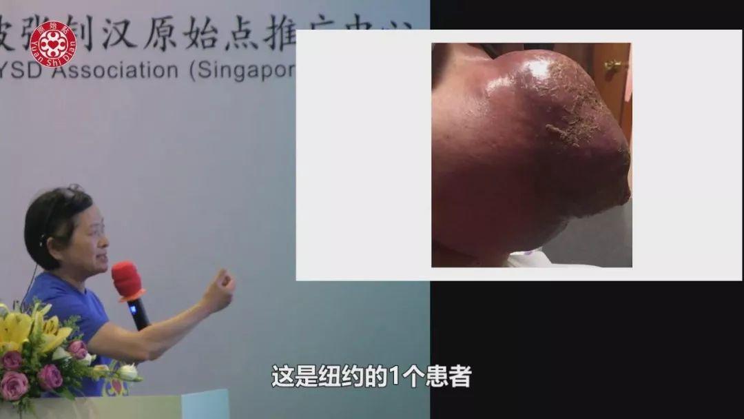 乳癌案例(2)-紅腫脹痛儲出血(紐約)