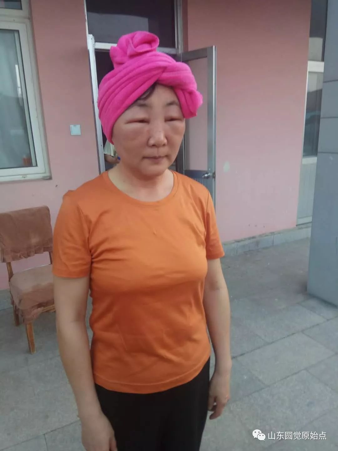 山東原始點案例：化妝品過敏臉部浮腫