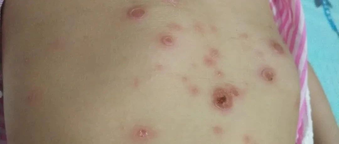 案例分享:原始點調理兩歲兒童全身膿包潰爛流膿案例。-七不姜 生姜養生網-明德CSA生態姜園&明安農業