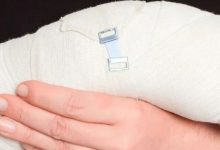 案例分享:撓骨骨折、錯位,調理十天見效的案例-七不姜 生姜養生網-明德CSA生態姜園&明安農業