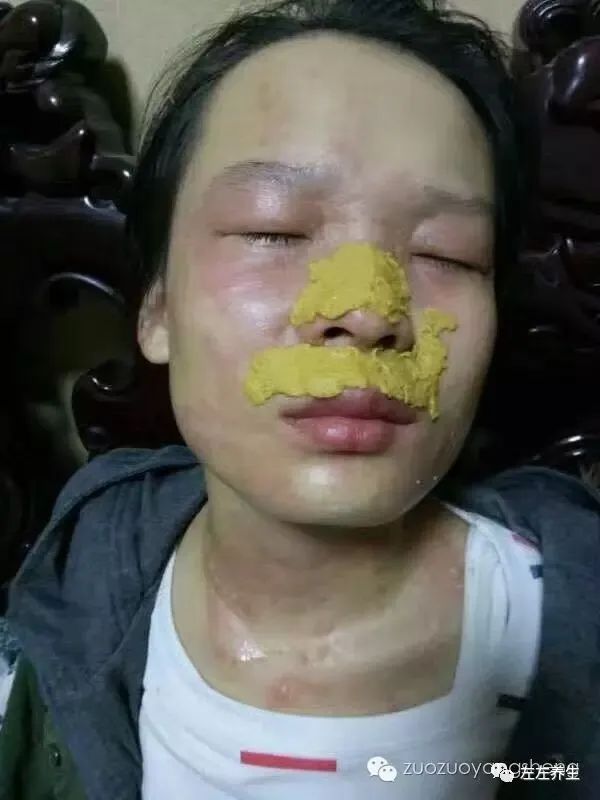 案例分享：花季少女面部燙傷不留疤的調理案例