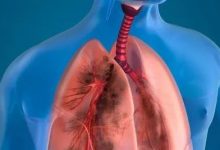 案例分享:71歲老人膀胱癌調理案例-七不姜 生姜養生網-明德CSA生態姜園&明安農業