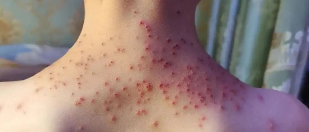 【原始點案例】原始點調理孩子水痘案例!-七不姜 生姜養生網-明德CSA生態姜園&明安農業