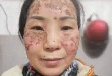 案例分享:臉上嚴重皮膚過敏調理案例-七不姜 生姜養生網-明德CSA生態姜園&明安農業