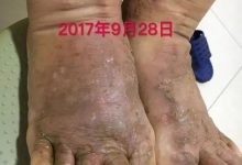 案例分享:全身奇癢無比的濕疹案例-七不姜 生姜養生網-明德CSA生態姜園&明安農業