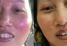 案例分享:臉上玫瑰痤瘡調理案例-七不姜 生姜養生網-明德CSA生態姜園&明安農業