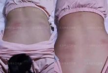 案例分享:20歲女孩脊柱嚴重側彎、盆骨突出、走路高低腳的案例-七不姜 生姜養生網-明德CSA生態姜園&明安農業