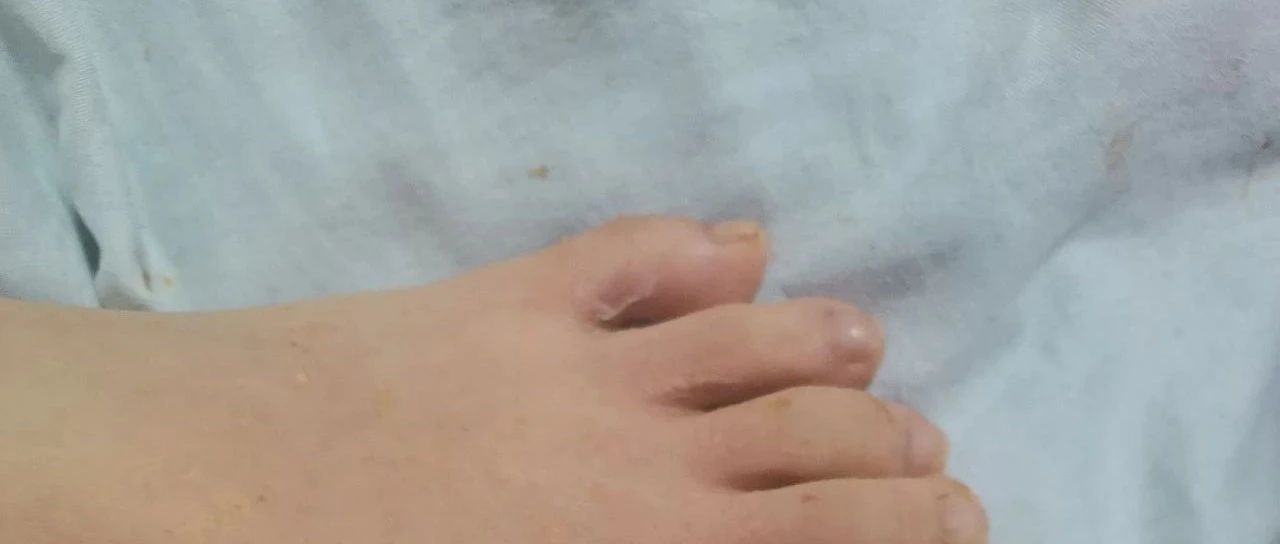 開水燙傷腳部 10歲男孩,2025年3月4號晚上洗腳時-七不姜 生姜養生網-明德CSA生態姜園&明安農業