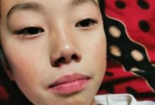 案例分享:兒童淋巴結腫大、腺樣體肥大、張嘴呼吸的案例-七不姜 生姜養生網-明德CSA生態姜園&明安農業