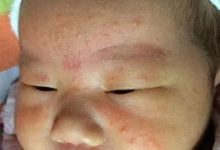 嬰幼兒濕疹怎么辦?(附手法視頻)-七不姜 生姜養生網-明德CSA生態姜園&明安農業