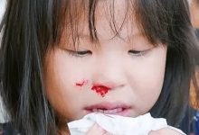 微問答283期:孩子頻繁流鼻血原始點如何處理?-七不姜 生姜養生網-明德CSA生態姜園&明安農業