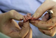 案例回訪:三年前那位沒去做心臟瓣膜置換術的女士情況怎么樣了?-七不姜 生姜養生網-明德CSA生態姜園&明安農業