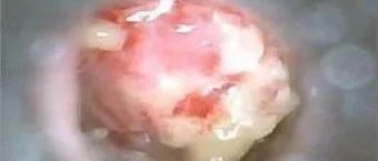 【原始點醫學】30年中耳炎案例-七不姜 生姜養生網-明德CSA生態姜園&明安農業