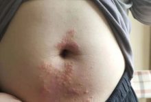 案例分享:腹部奇癢無比濕疹調理案例-七不姜 生姜養生網-明德CSA生態姜園&明安農業