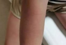 案例分享:突發性過敏全身癢調理案例-七不姜 生姜養生網-明德CSA生態姜園&明安農業