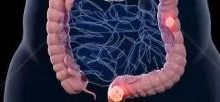 案例分享:直腸癌轉肺癌調理案例-七不姜 生姜養生網-明德CSA生態姜園&明安農業