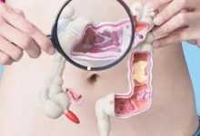 案例分享:腸梗阻住院兩天后調理案例-七不姜 生姜養生網-明德CSA生態姜園&明安農業