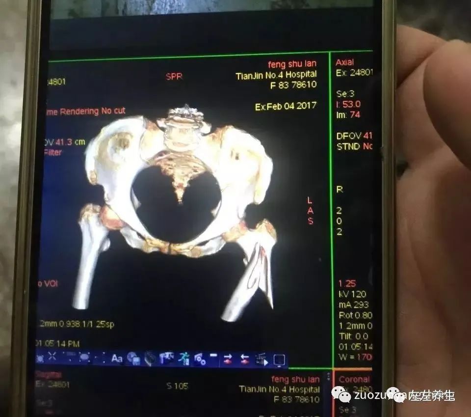 案例分享:又一奇跡:83歲婆婆骨折錯位沒開刀沒手術6周康復 案例分享:又一奇跡:83歲婆婆骨折錯位沒開刀沒手術6周康復