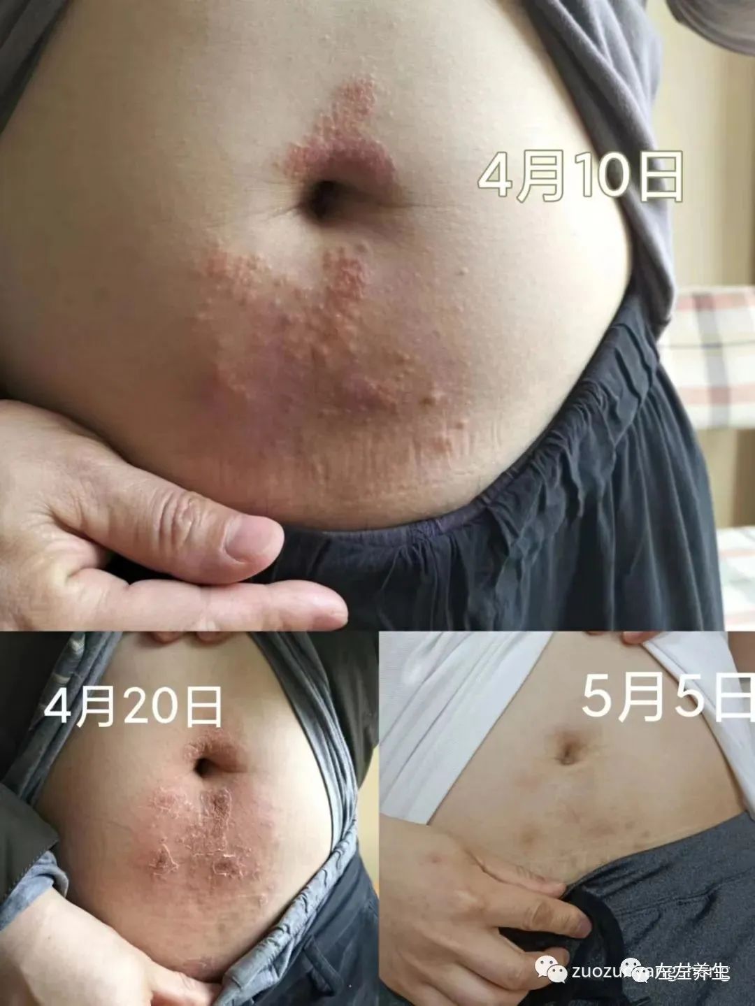 案例分享：腹部奇癢無比濕疹調理案例