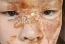 案例分享:花季少女面部燙傷不留疤的調理案例-七不姜 生姜養生網-明德CSA生態姜園&明安農業