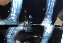 案例分享:三歲孩子右腿骨折調理案例-七不姜 生姜養生網-明德CSA生態姜園&明安農業