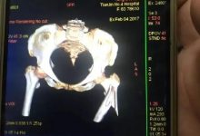 案例分享:又一奇跡:83歲婆婆骨折錯位沒開刀沒手術6周康復-七不姜 生姜養生網-明德CSA生態姜園&明安農業