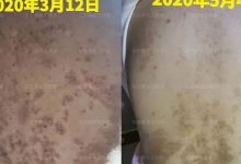 案例分享:產后高血壓、全身奇癢無比調理案例-七不姜 生姜養生網-明德CSA生態姜園&明安農業