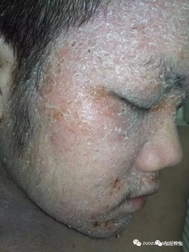 案例分享：馬來西亞男孩嚴重濕疹、十天后大變樣