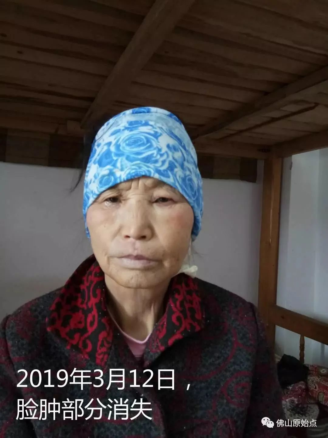 原始點調理牙痛案例