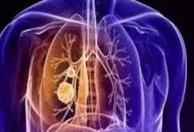 微問答7期:叔叔肺癌晚期如何調理?-七不姜 生姜養生網-明德CSA生態姜園&明安農業