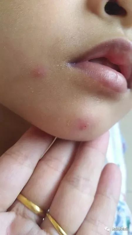 佛山原始點中心學員花開深圳:媽媽用原始點為七歲兒調理水痘9天康復案例 佛山原始點中心學員花開深圳:媽媽用原始點為七歲兒調理水痘9天康復案例