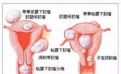 中醫解讀子宮肌瘤、卵巢囊腫是怎么回事？