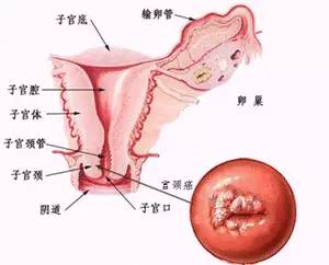 原始點調理晚期子宮癌康復案例+回訪記錄