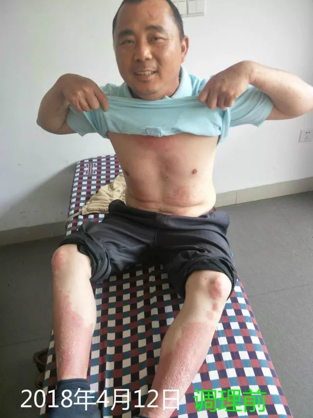 原始點調理十五年病史牛皮癬：30天大變樣