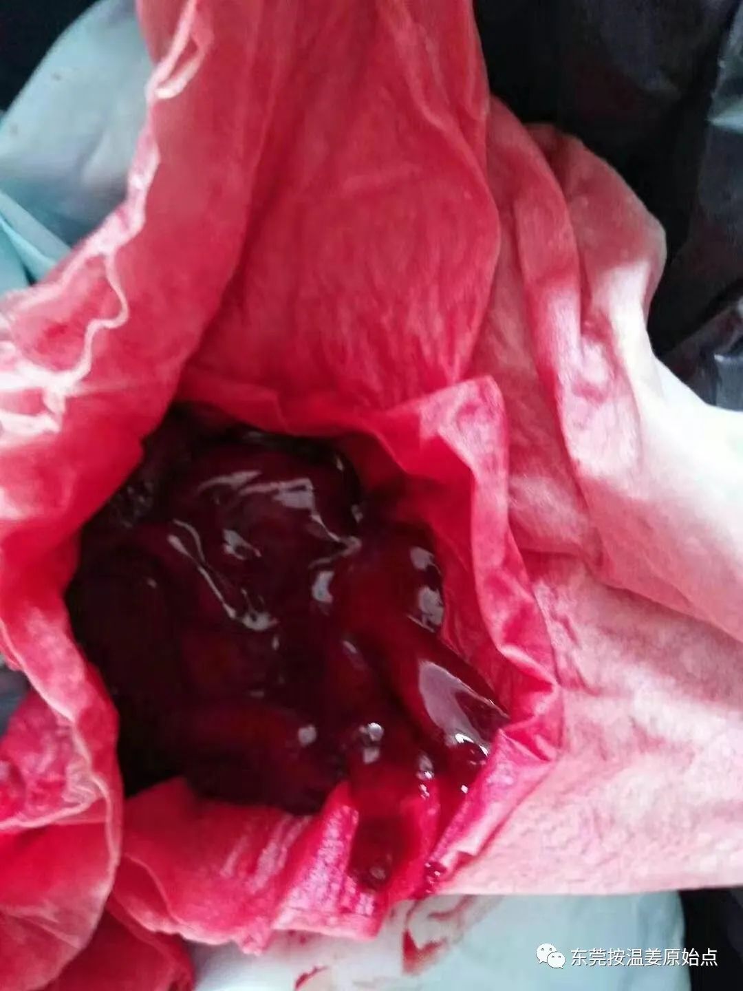 用原始點排出死胎，免除刮宮手術